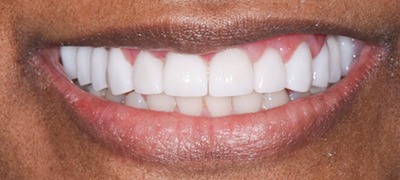 closeup of perfect smile after cosmetic dentistry