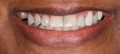 closeup of imperfect smile before cosmetic dentistry