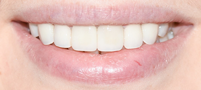 closeup of perfect smile after cosmetic dentistry