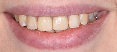 closeup of imperfect smile before cosmetic dentistry