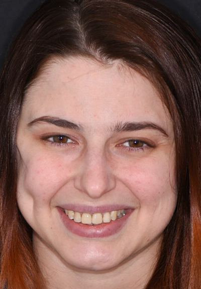 Patient with imperfect smile before cosmetic dentistry