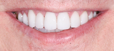 closeup of perfect smile after cosmetic dentistry