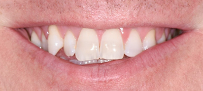 closeup of imperfect smile before cosmetic dentistry