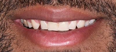 closeup of perfect smile after cosmetic dentistry