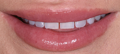 closeup of imperfect smile before cosmetic dentistry