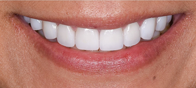 closeup of perfect smile after cosmetic dentistry