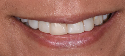 closeup of imperfect smile before cosmetic dentistry