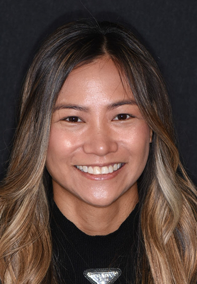 Patient with imperfect smile before cosmetic dentistry