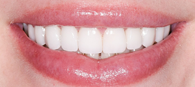 closeup of perfect smile after cosmetic dentistry