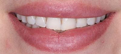 closeup of imperfect smile before cosmetic dentistry