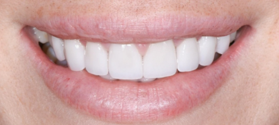 closeup of perfect smile after cosmetic dentistry