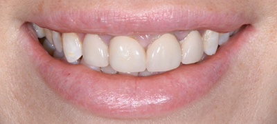 closeup of imperfect smile before cosmetic dentistry