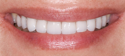 closeup of perfect smile after cosmetic dentistry
