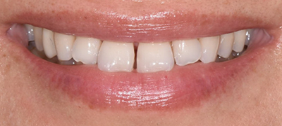 closeup of imperfect smile before cosmetic dentistry