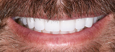 closeup of perfect smile after cosmetic dentistry