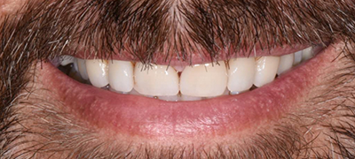 closeup of imperfect smile before cosmetic dentistry