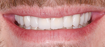 closeup of perfect smile after cosmetic dentistry