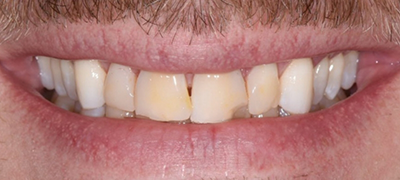 closeup of imperfect smile before cosmetic dentistry