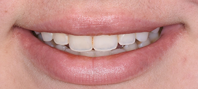 closeup of imperfect smile before cosmetic dentistry