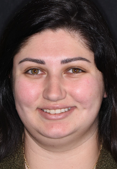 Patient with imperfect smile before cosmetic dentistry