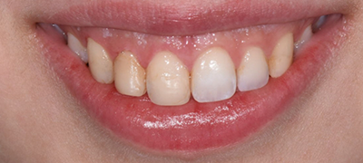 closeup of imperfect smile before cosmetic dentistry
