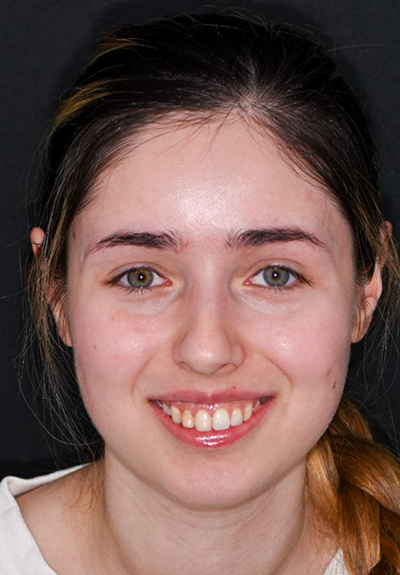Patient with imperfect smile before cosmetic dentistry