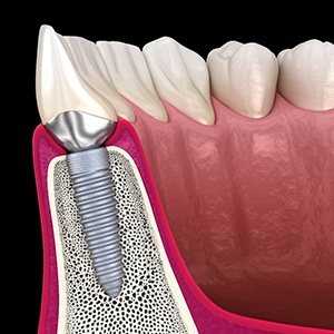 an illustration of a dental implant undergoing osseointegration