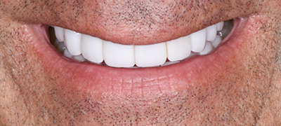 closeup of perfect smile after cosmetic dentistry