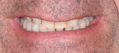 closeup of imperfect smile before cosmetic dentistry