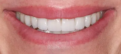 Patient with gorgeous smile after cosmetic dentistry