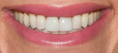 Patient with imperfect smile before cosmetic dentistry