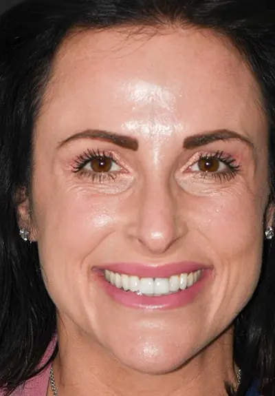 closeup of imperfect smile before cosmetic dentistry
