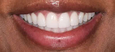 Patient with gorgeous smile after cosmetic dentistry