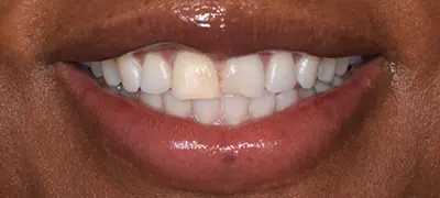 Patient with imperfect smile before cosmetic dentistry