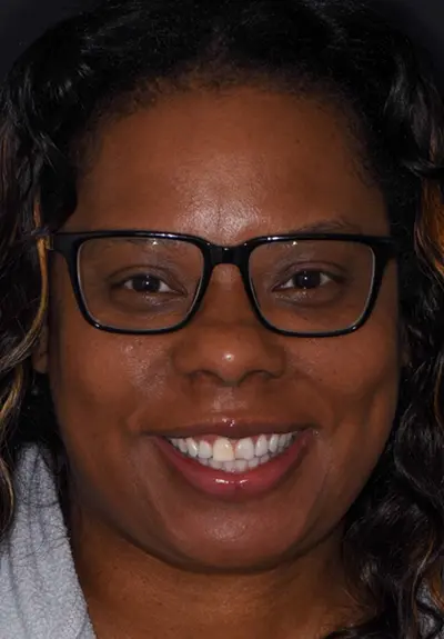 closeup of imperfect smile before cosmetic dentistry