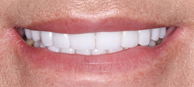 closeup of perfect smile after cosmetic dentistry