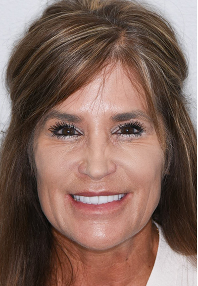 Patient with gorgeous smile after cosmetic dentistry