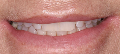 closeup of imperfect smile before cosmetic dentistry