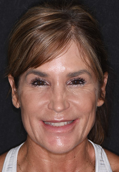 Patient with imperfect smile before cosmetic dentistry
