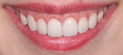 Patient with gorgeous smile after cosmetic dentistry