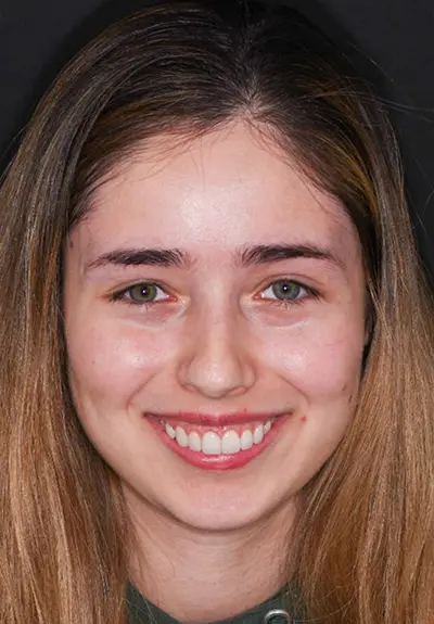 closeup of perfect smile after cosmetic dentistry