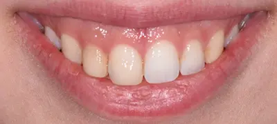 Patient with imperfect smile before cosmetic dentistry