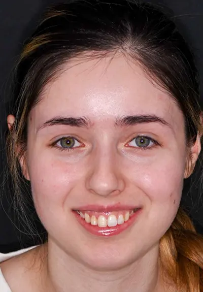 closeup of imperfect smile before cosmetic dentistry
