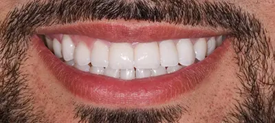 Patient with gorgeous smile after cosmetic dentistry