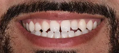 Patient with imperfect smile before cosmetic dentistry