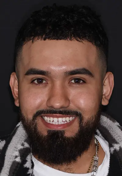 closeup of imperfect smile before cosmetic dentistry