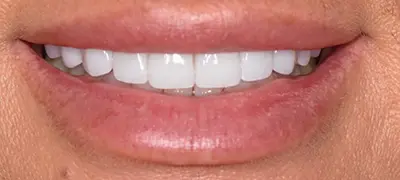 Patient with gorgeous smile after cosmetic dentistry