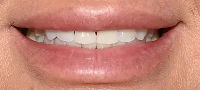 Patient with imperfect smile before cosmetic dentistry