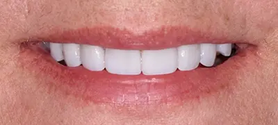 Patient with gorgeous smile after cosmetic dentistry
