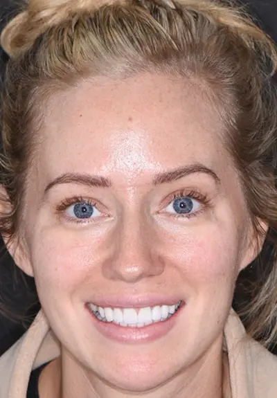 closeup of perfect smile after cosmetic dentistry